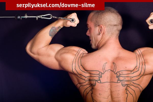 dövme silme