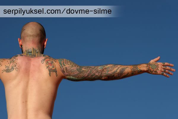 dövme silme