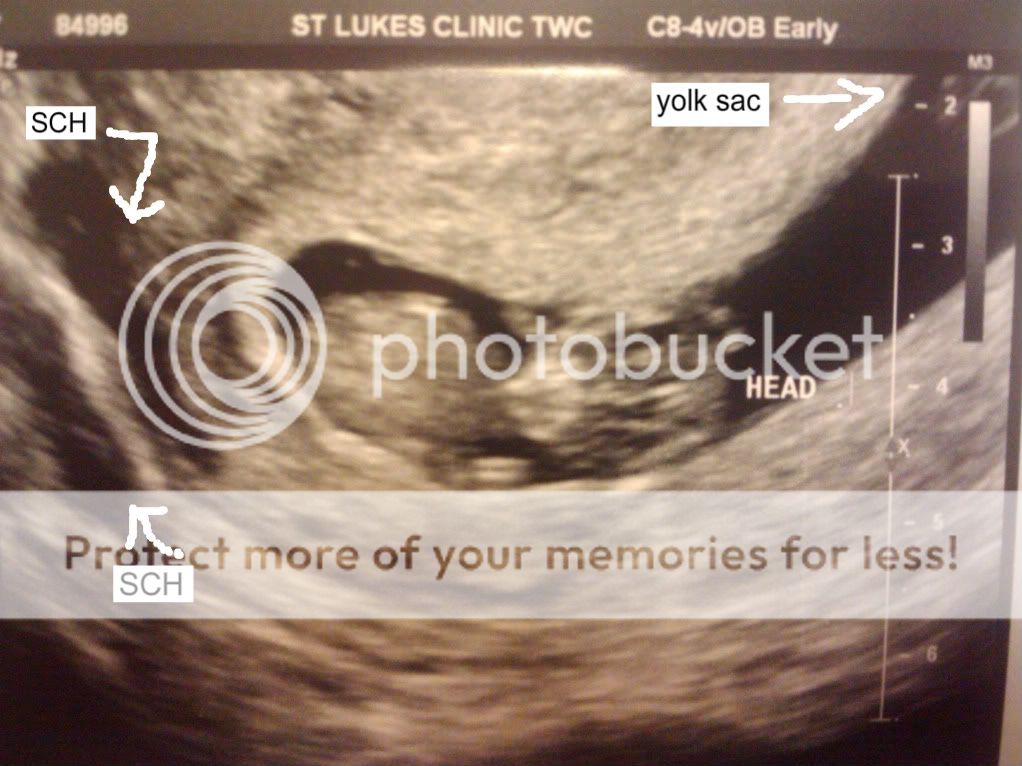 Odd shaped Gestational Sac (GS) BabyCenter